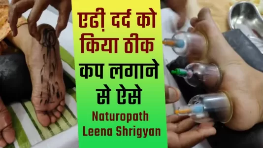 कपिंग