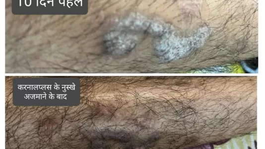 Psoriasis