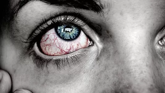 eye flu